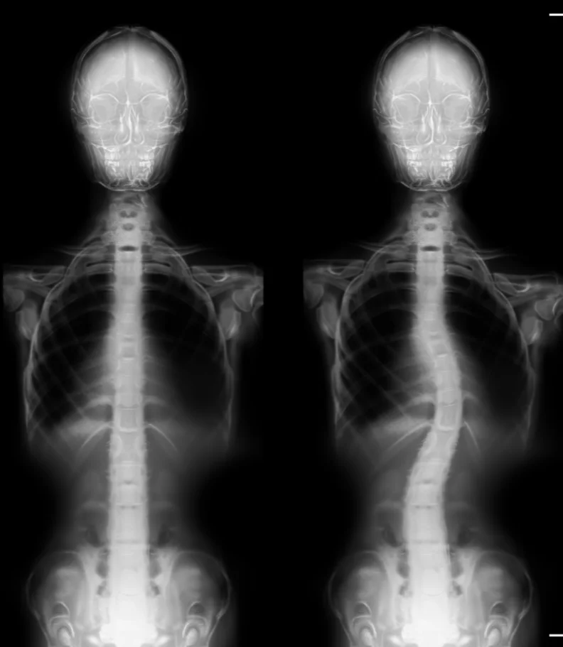 Scoliosis Tampa